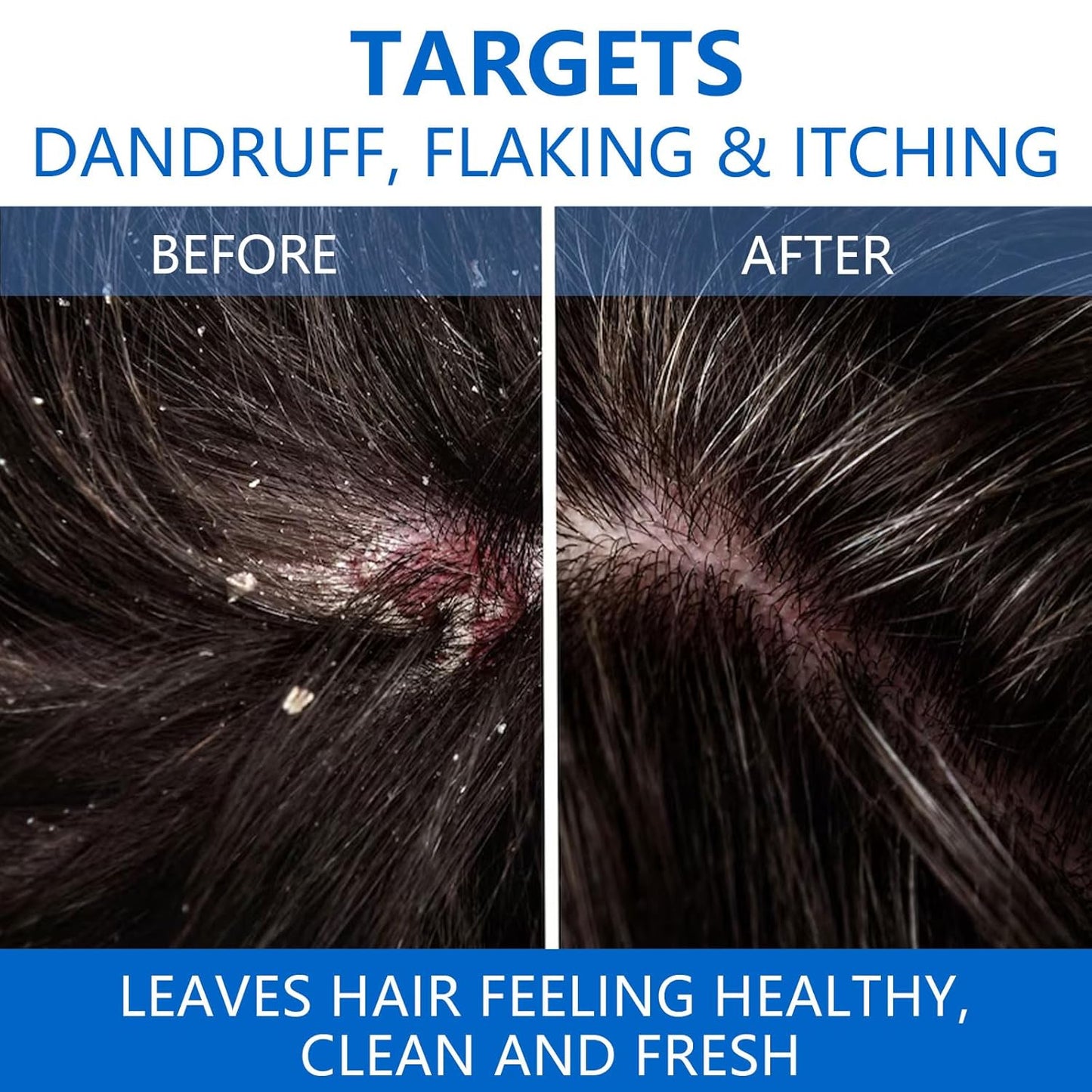 【Limited Time Offer】Selenium Disulfide Hair Care Shampoo-KY