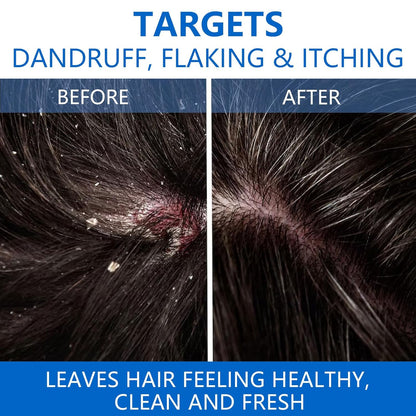 【Limited Time Offer】Selenium Disulfide Hair Care Shampoo-KY